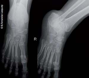 Fractura por fatiga del segundo metatarsiano